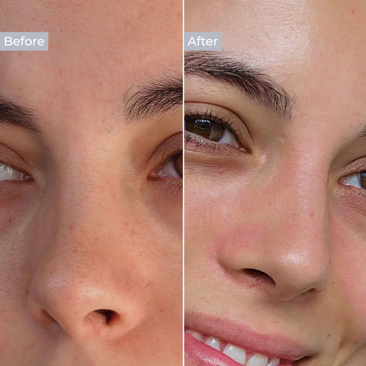 Hydrocolloid Nose Patch