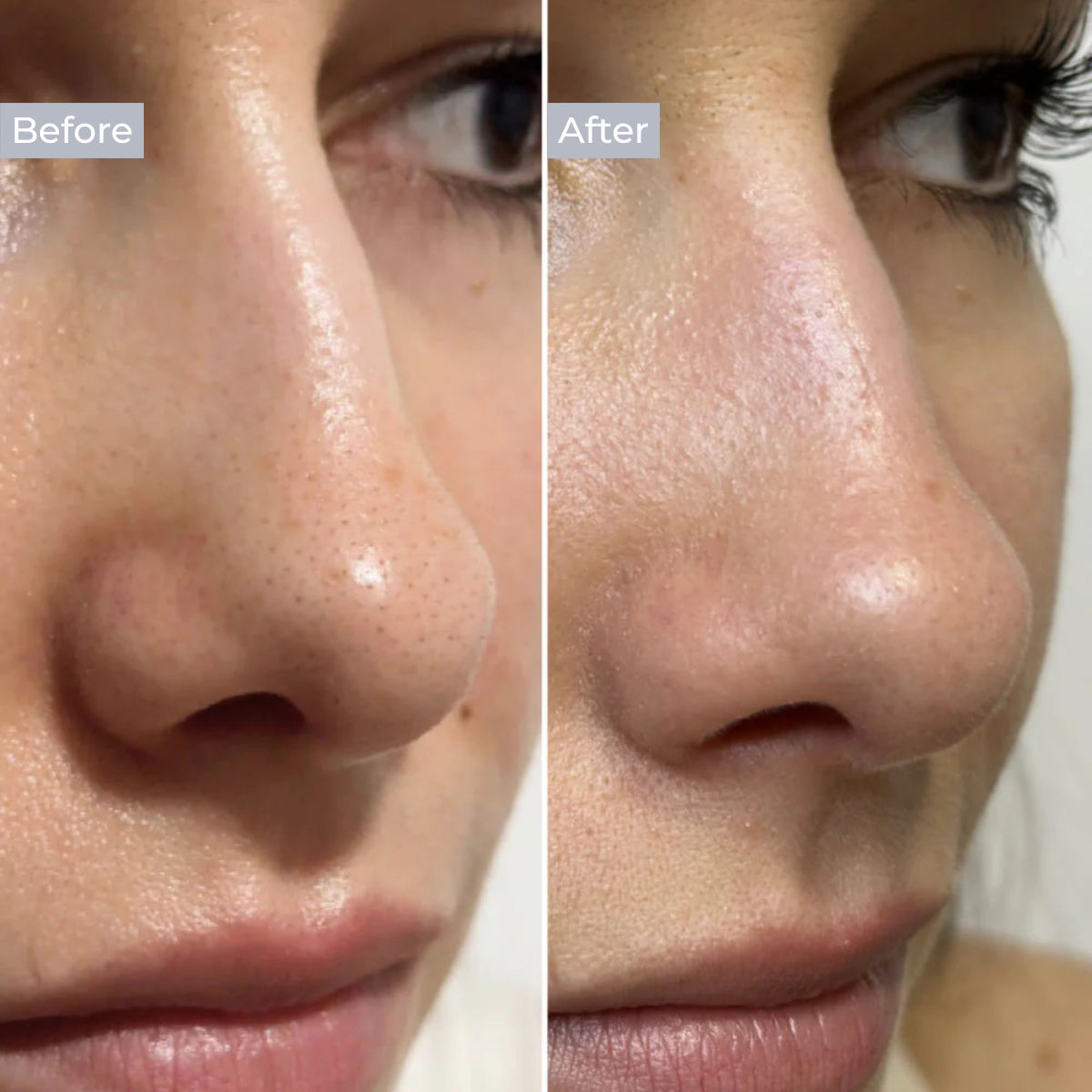 Hydrocolloid Nose Patch