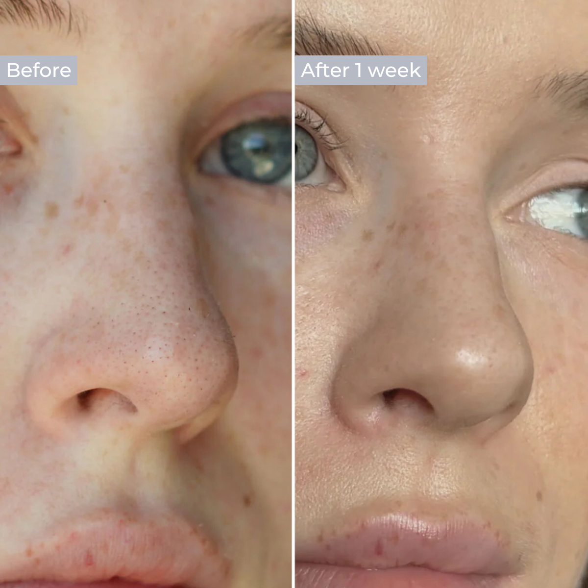 Hydrocolloid Nose Patch