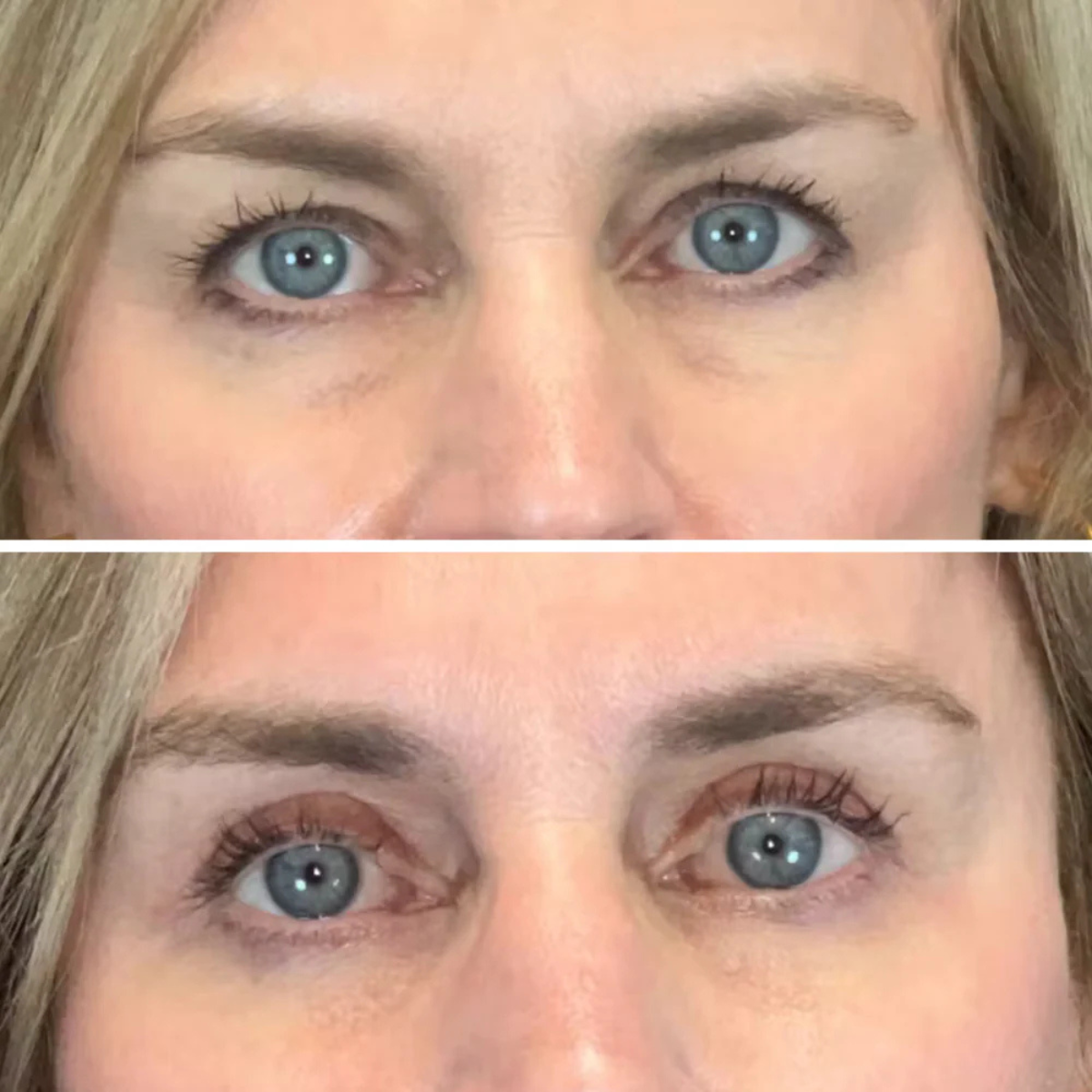 Microneedle Eye Patches