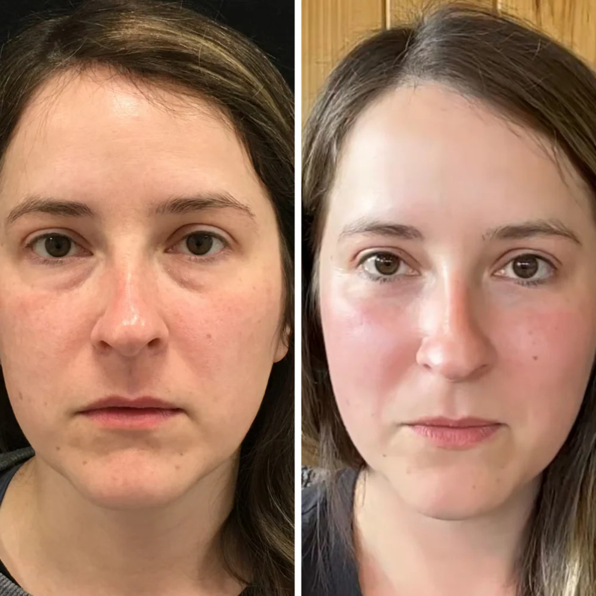 Microneedle Eye Patches
