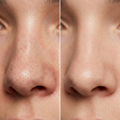 Hydrocolloid Nose Patch
