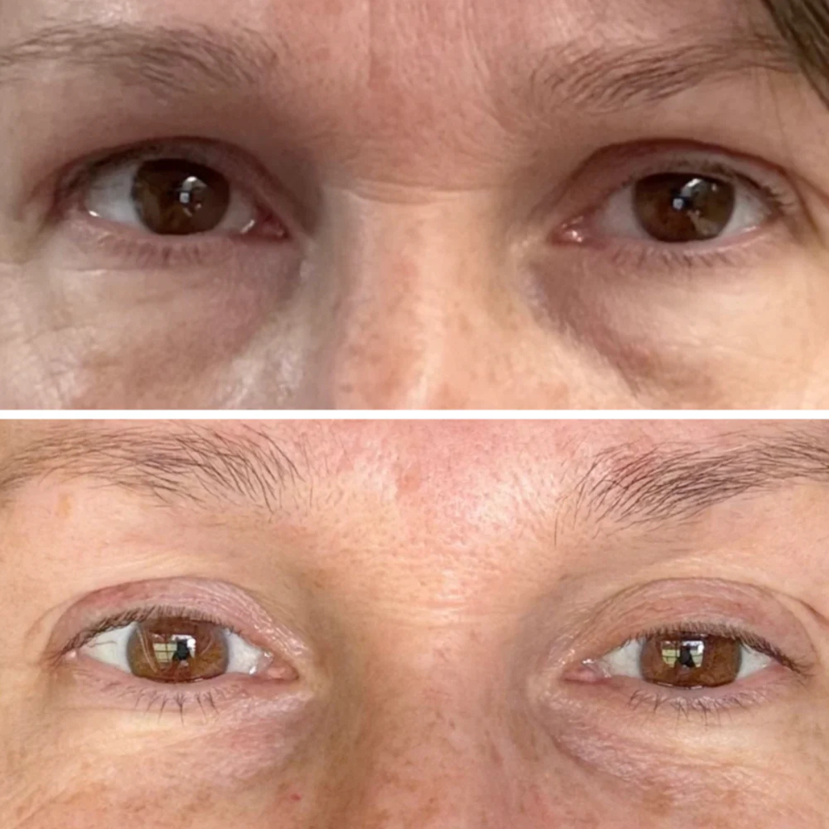 Microneedle Eye Patches