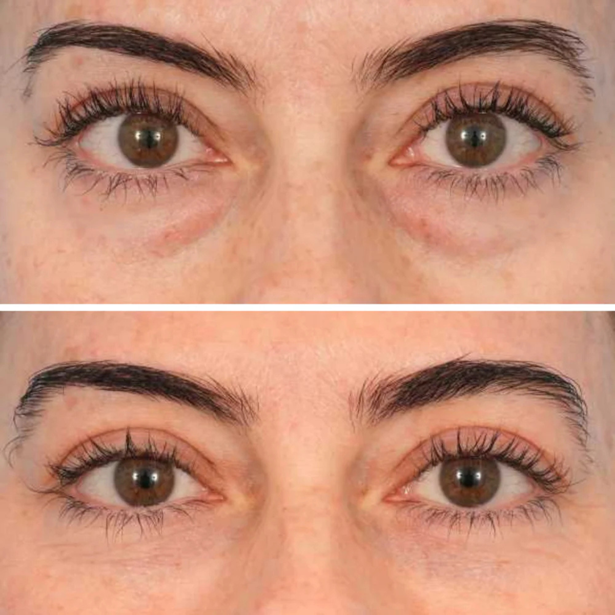 Microneedle Eye Patches