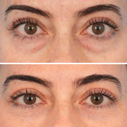 Microneedle Eye Patches