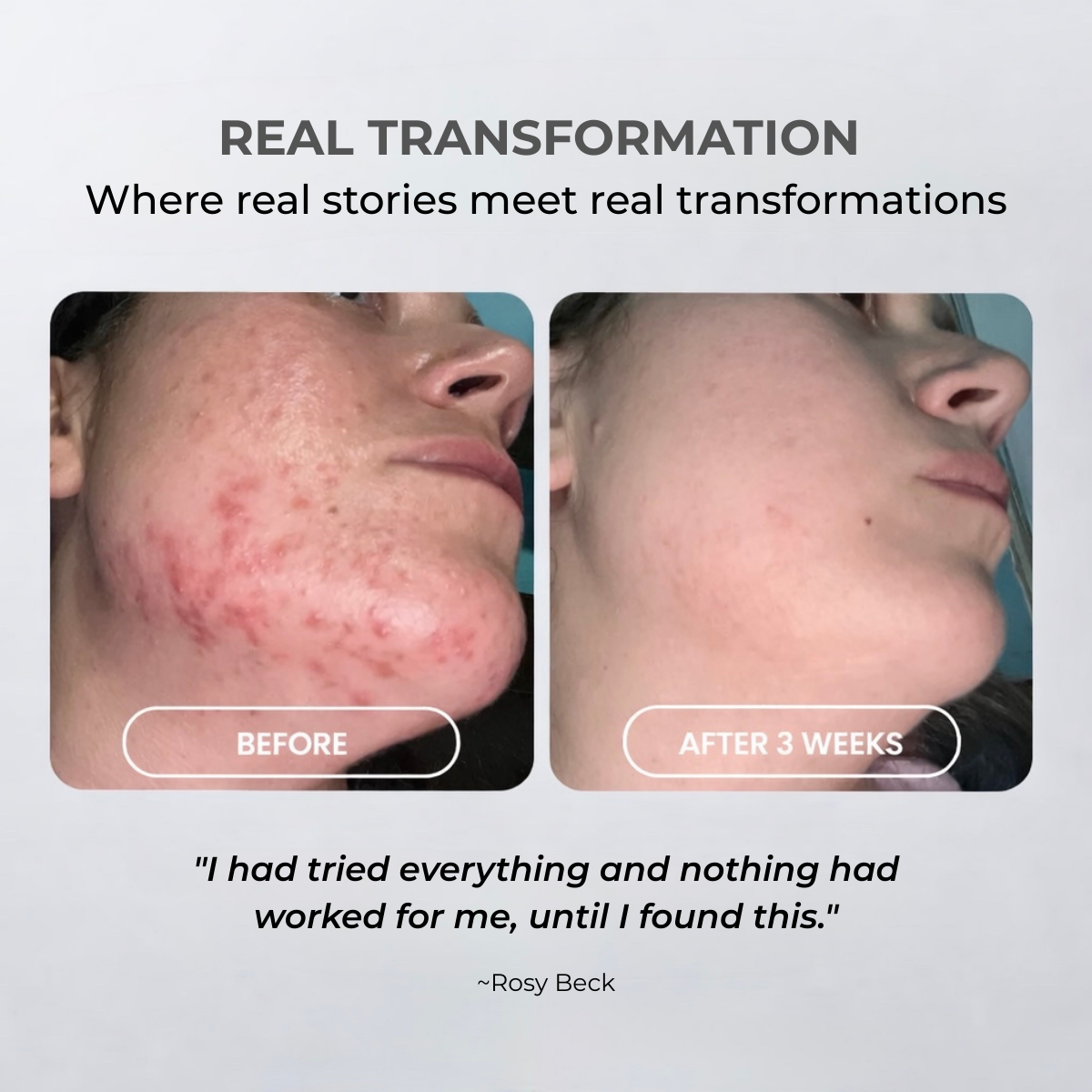 DermaPulse™ High-Frequency Skin Wand