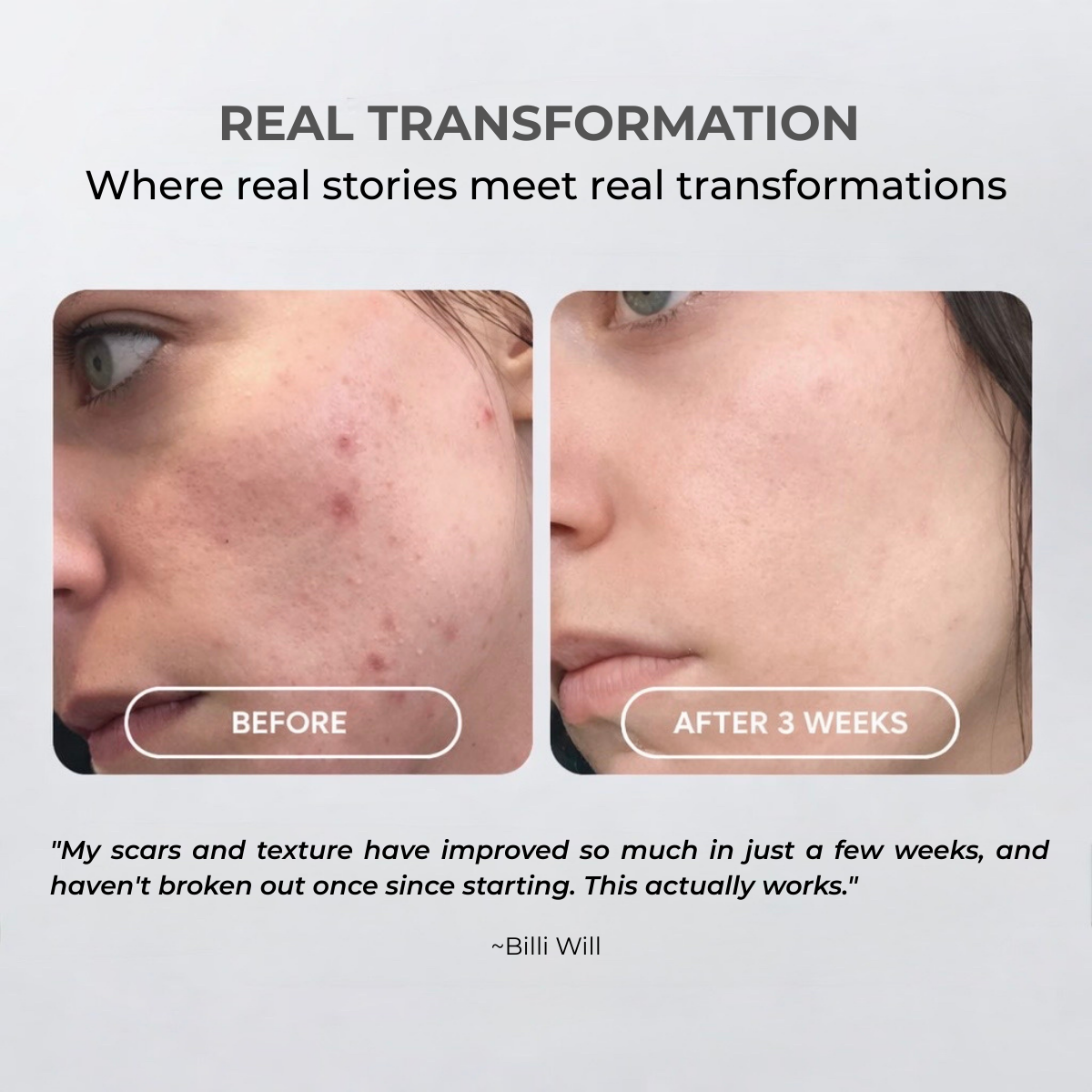 DermaPulse™ High-Frequency Skin Wand